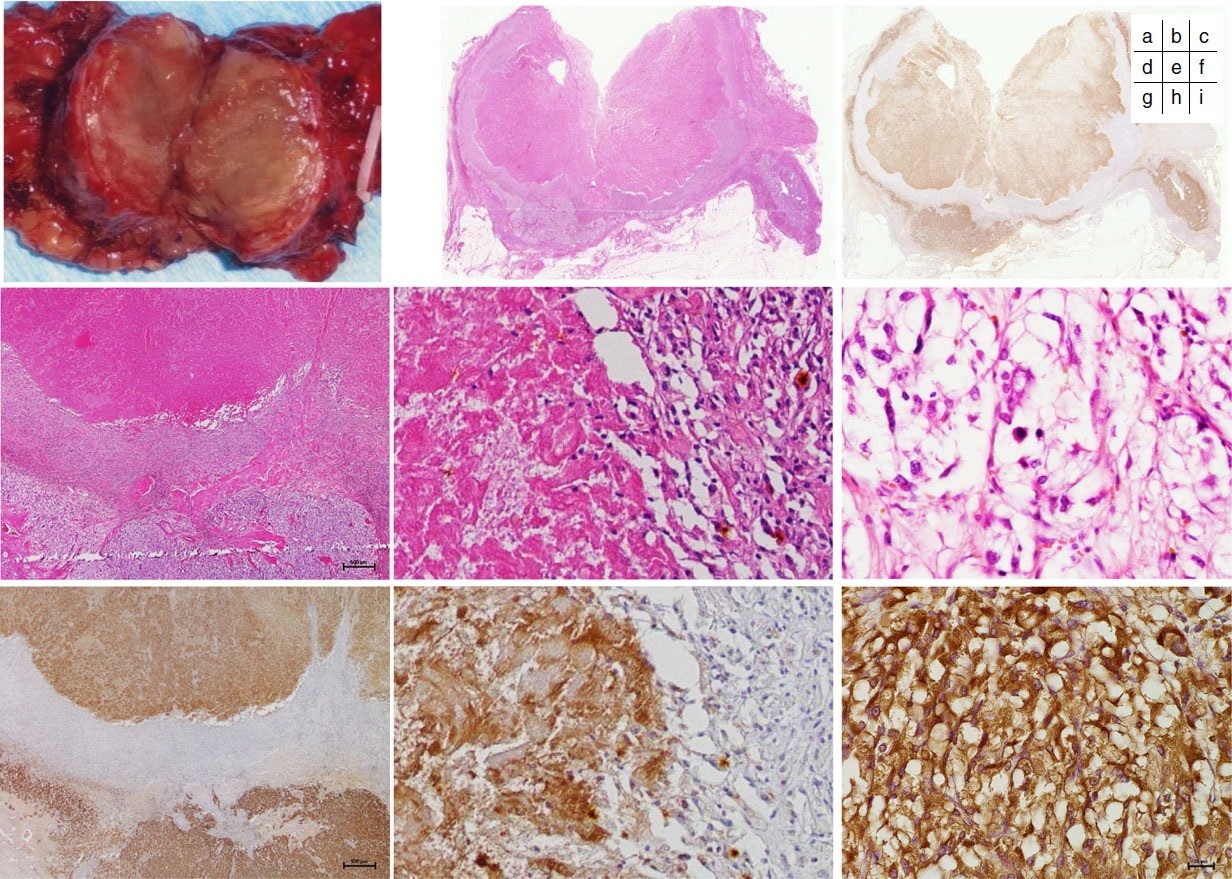 Hipertensión arterial - Wikipedia, la enciclopedia libre