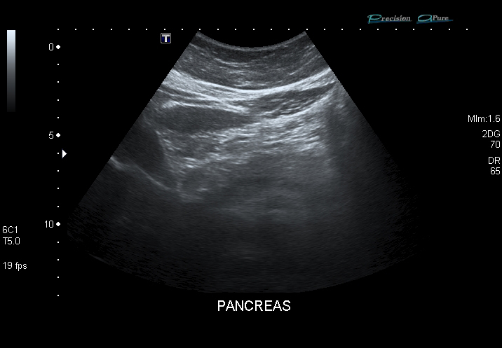 pancreas ultrasound
