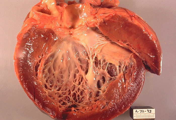 takotsubo cardiomyopathy symptoms