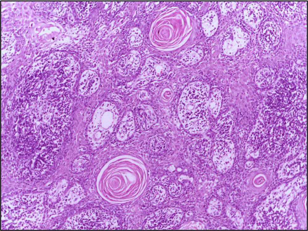 squamous cell carcinoma skin histology