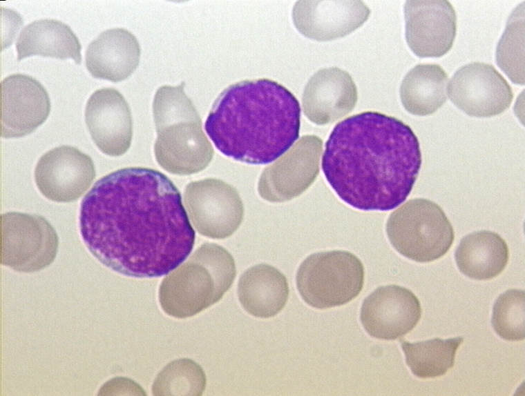 File:ALL - Peripherial Blood - Diagnosis - 01.jpg