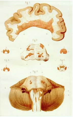 File:Cervello sclerosi multipla.jpg