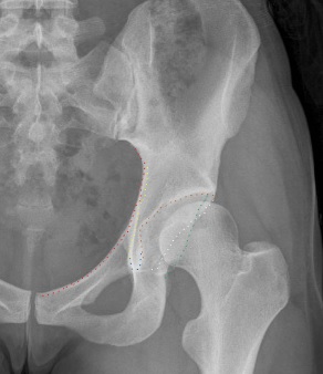 File:Iliopectineal line (red), ilioischial line (yellow), tear drop (blue), acetabular fossa (brown), and anterior (white) and posterior (green) wall of the acetabuli.jpg