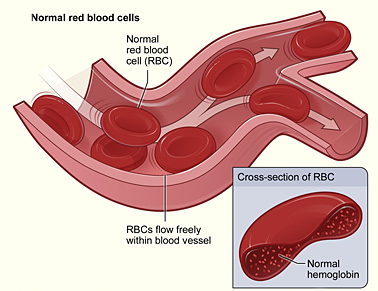 Normal red blood cells flowing freely in a blood vessel, with an inset showing a cross-section of a normal red blood cell with normal haemoglobin.