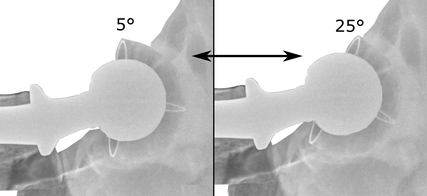 x ray femoral anteversion