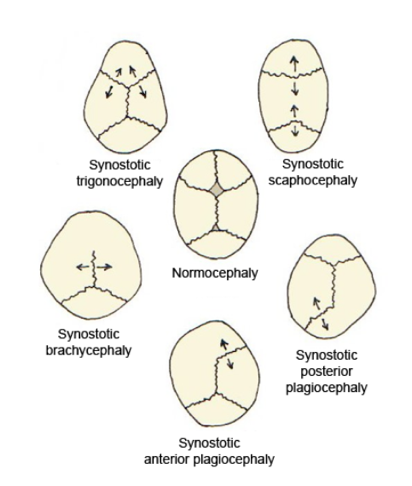 Plagiozephalie Wikipedia