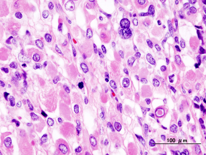 File:Uterine carcinosarcoma (4) rhabdomyosarcomatous.jpg