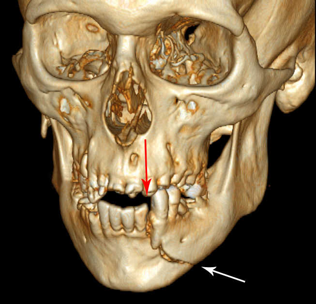 Mandible - Wikipedia