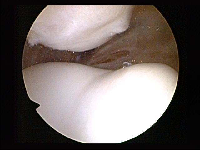 File:Patellofemoral articulation oblique view.jpg