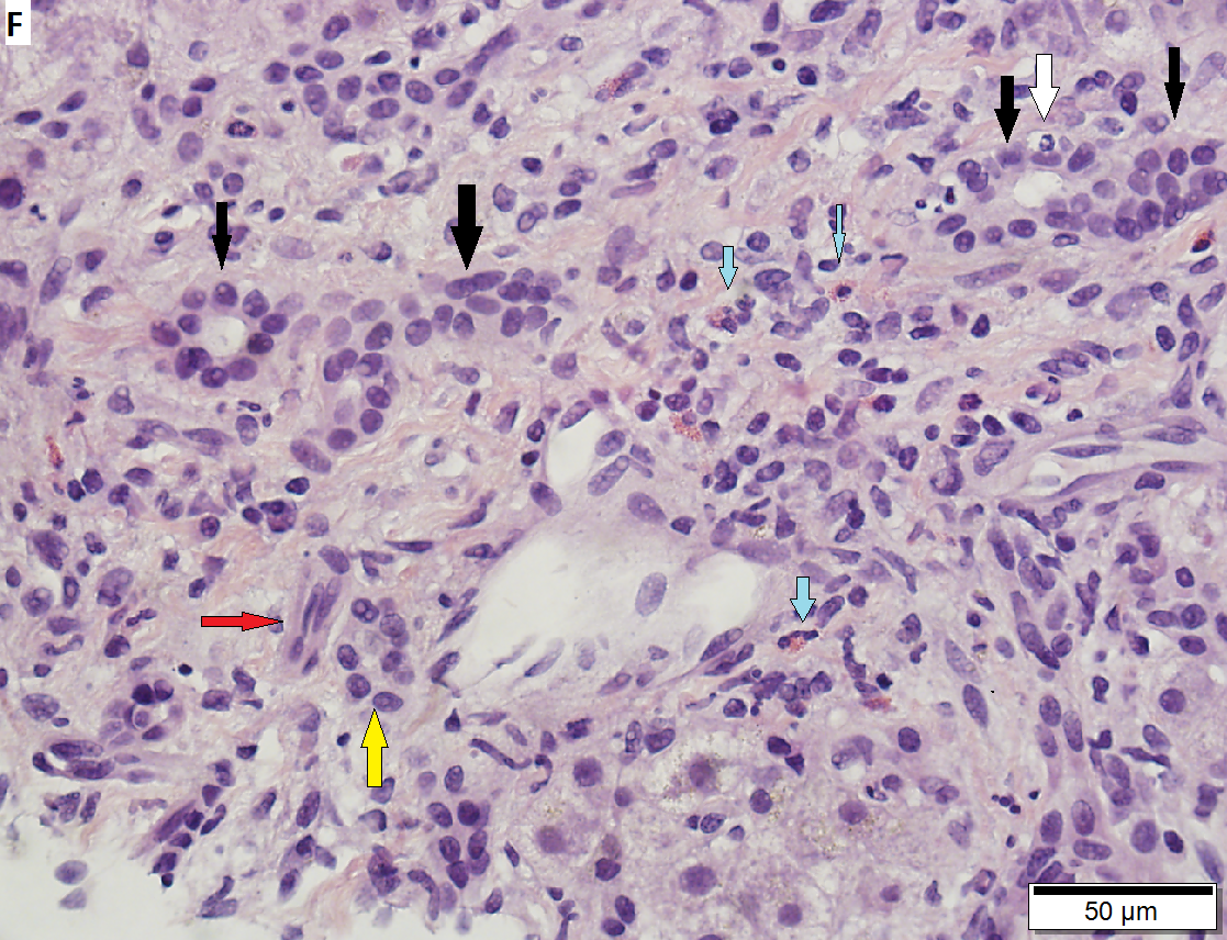 60 year old woman with poorly differentiated ampullary adenocarcinoma and obstructive cholestasis in liver