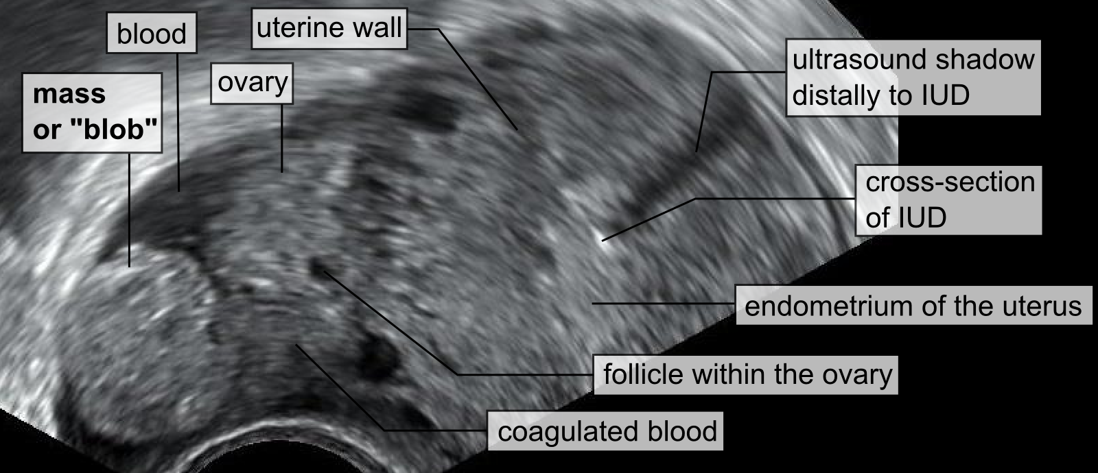 Fallopian tube - Wikipedia