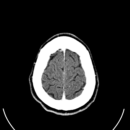 Computed tomography of human brain (28).png