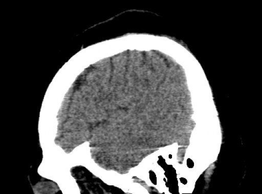 File:Morbus Fahr - CT - sagittal - 004.jpg