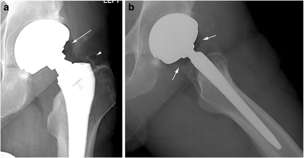 Hip replacement - Wikipedia