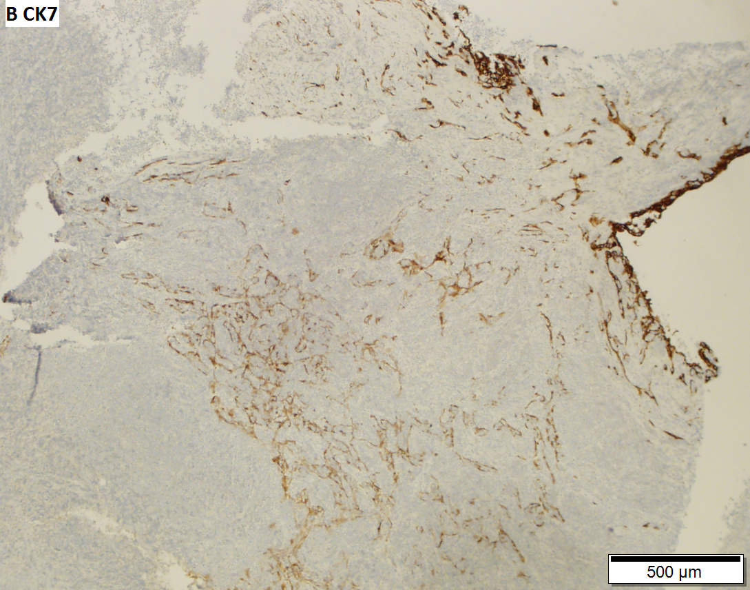 Thymoma type B1