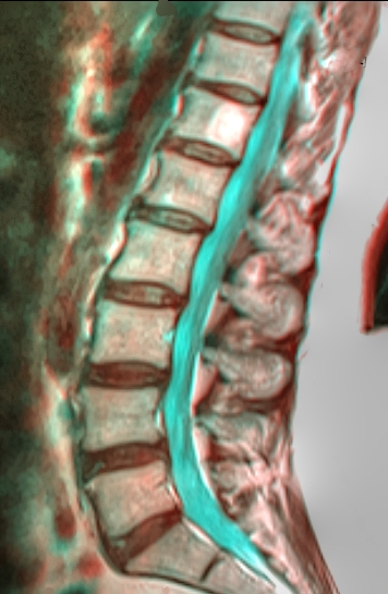 File:Lumbar MRI 130319 rgbc 54f.png