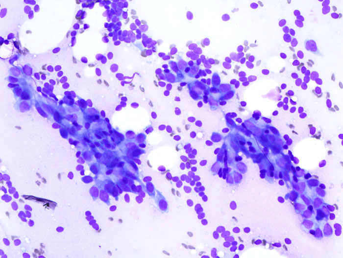 File:Breast fibroadenoma by fine needle aspiration (1) DG stain.jpg