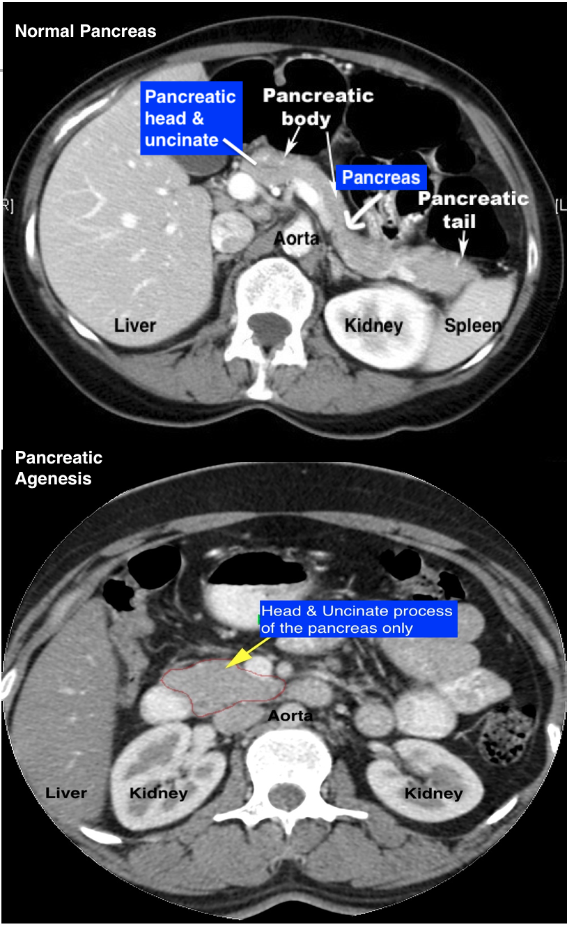 normal pancreas cat scan