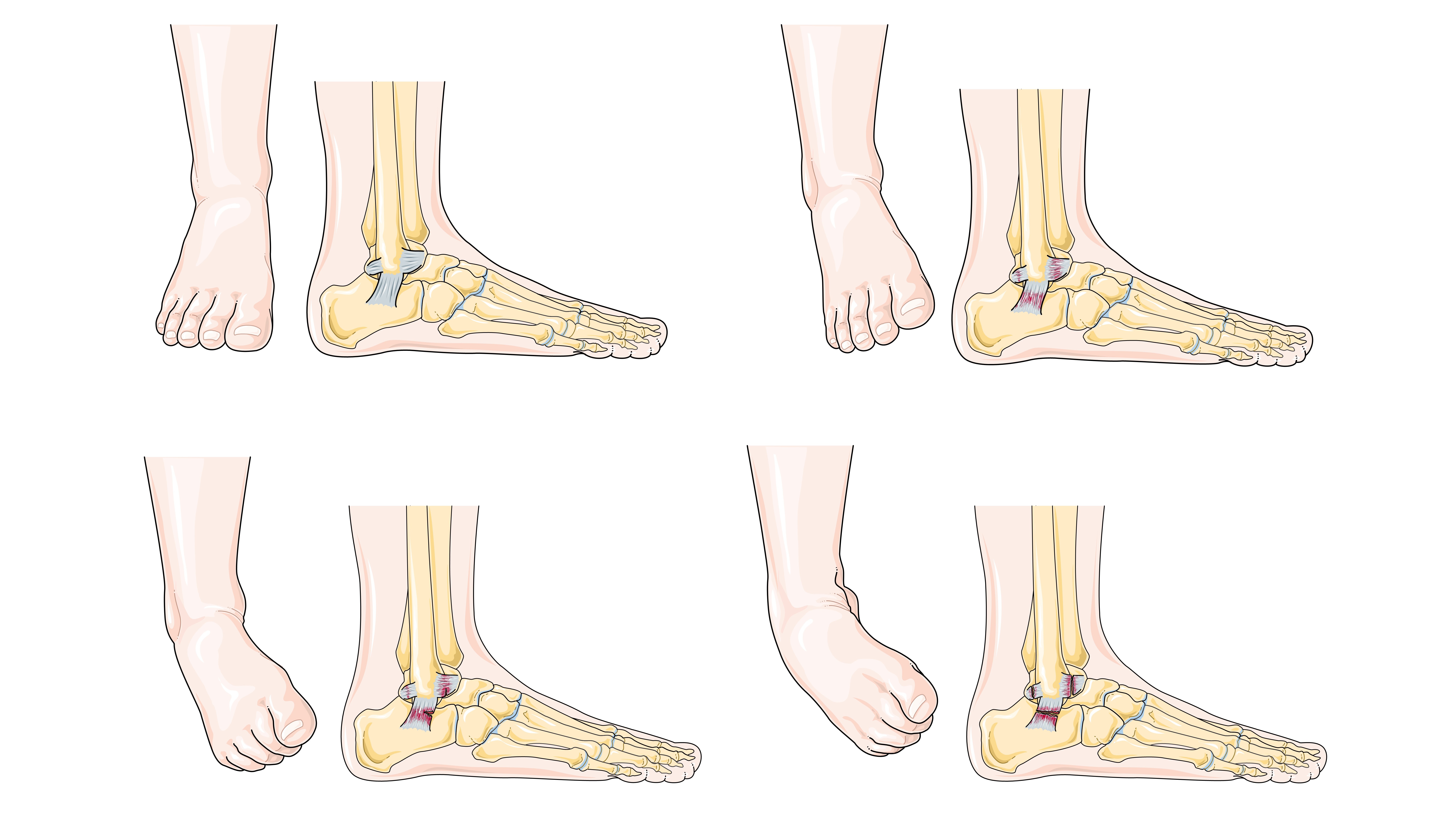 File:Ankle sprain -- Smart-Servier (cropped).jpg - Wikipedia