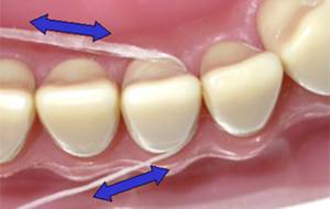 Afbeelding die het gebruik van tandzijde (flosdraad) demonstreert om tandplak tussen de tanden te verwijderen