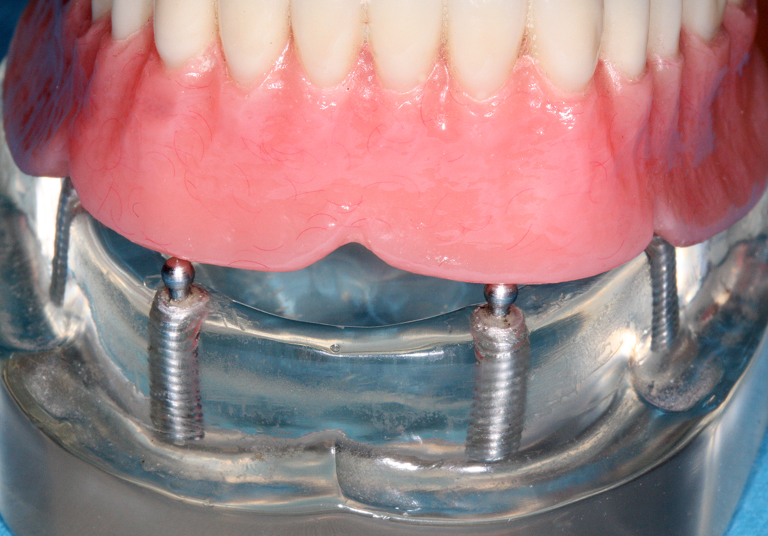 All-on-4 - Mini Dental Implants for Dentures - The Ivory Dental