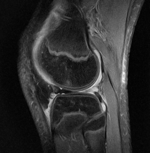 File:Korbhenkelriss Aussenmeniskus Hinterhorn - 12jw - MRT - PD FS sagittal - 023.jpg