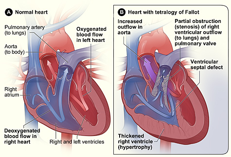 An  illustration showing the cross-section of a healthy heart and anatomy. The blue arrow shows the direction in which oxygen-poor blood flows from the body to the lungs. The red arrow shows the direction in which oxygen-rich blood flows from the lungs to the rest of the body.