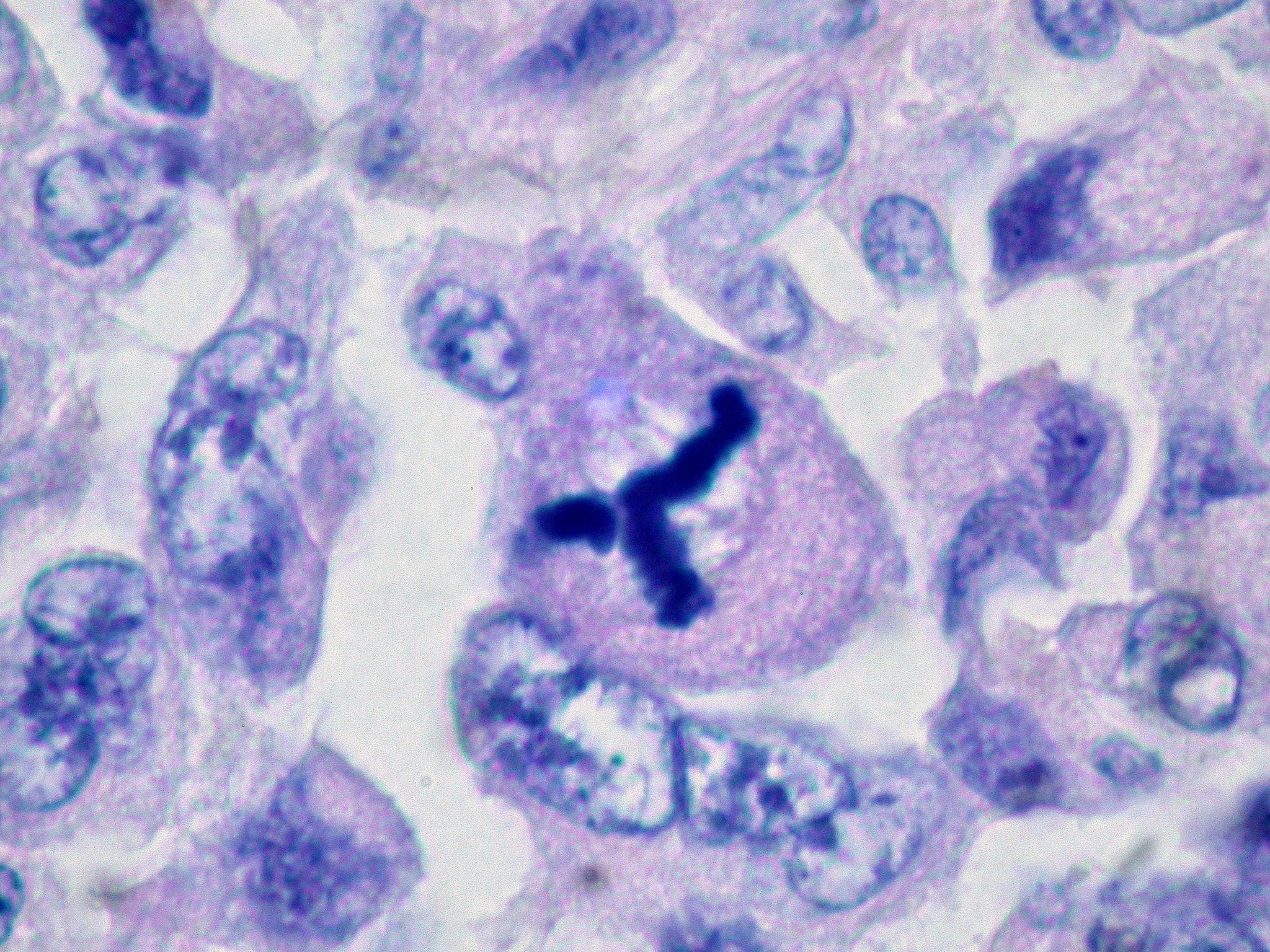 Sarcomatoid Carcinoma Wikipedia