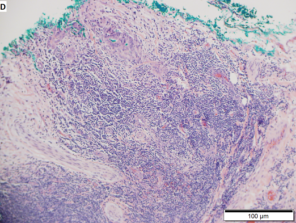 Moderately differentiated adenocarcinoma of gallbladder