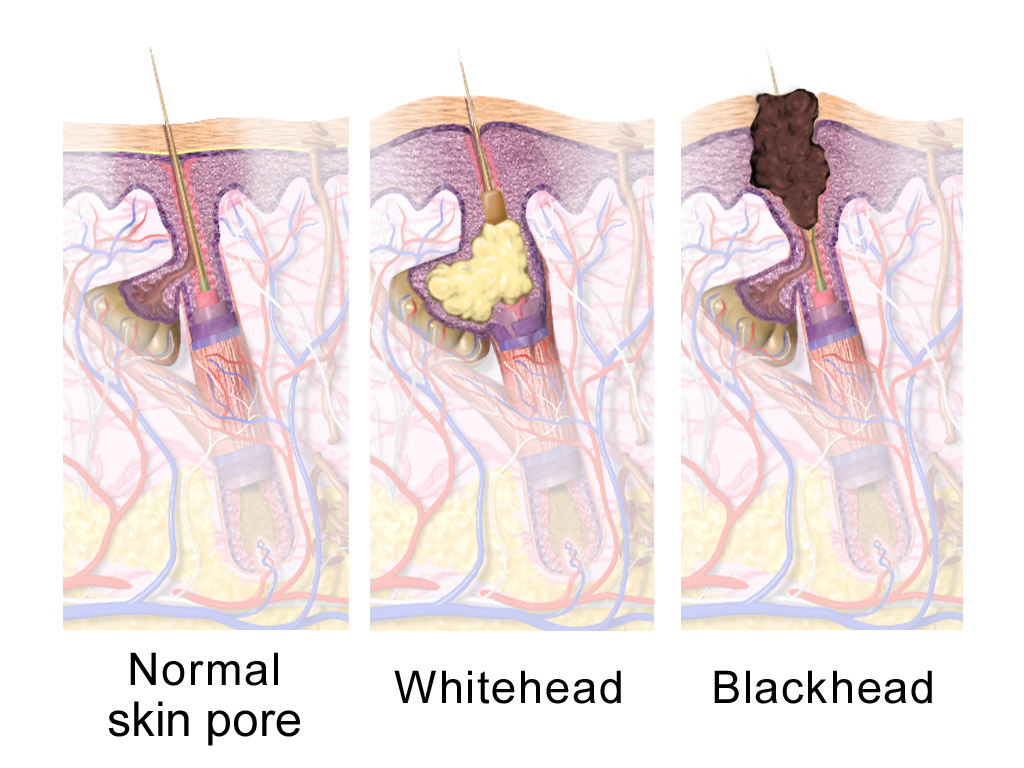 blackheads on shoulders