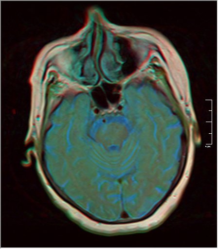 File:Brain MRI 0052 13.jpg