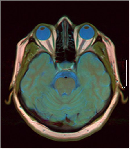 File:Brain MRI 0106 13.jpg