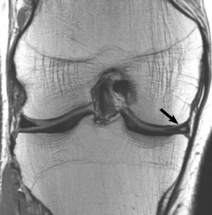 Ficheiro:Proton density MRI of a grade 2 medial meniscal tear.jpg