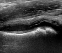 Joint effusion in transient synovitis of the hip.