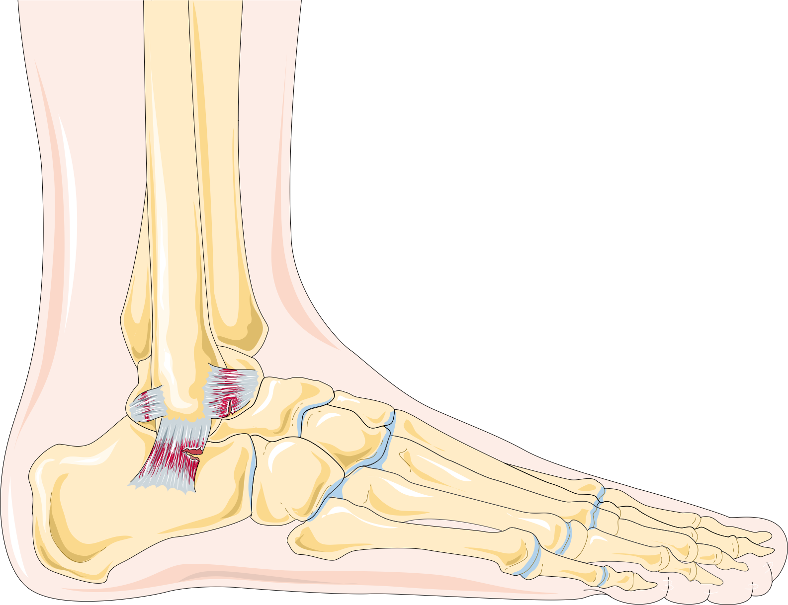 Fracture de la cheville — Wikipédia