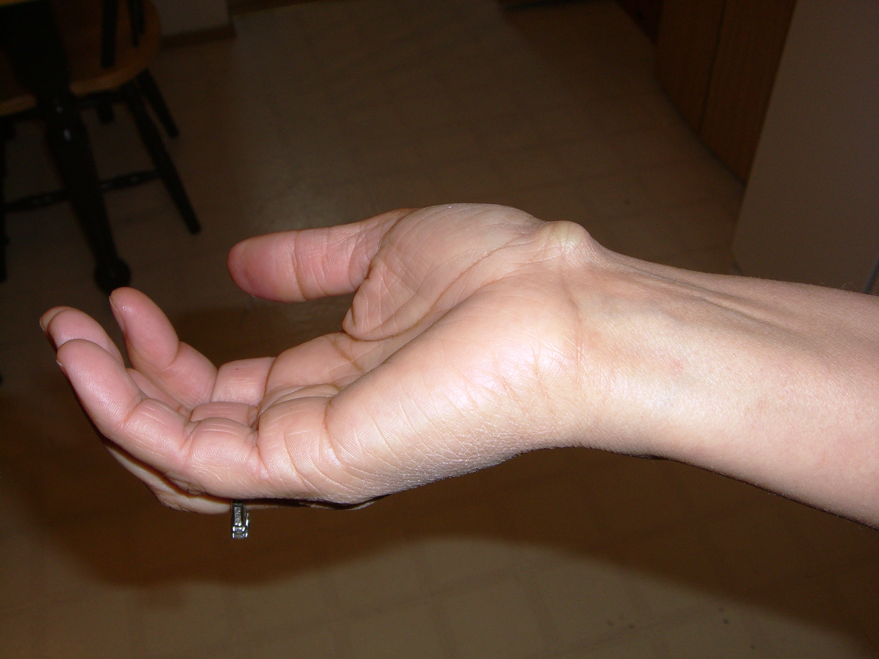 Гігрома на руці: симптоми та ознаки