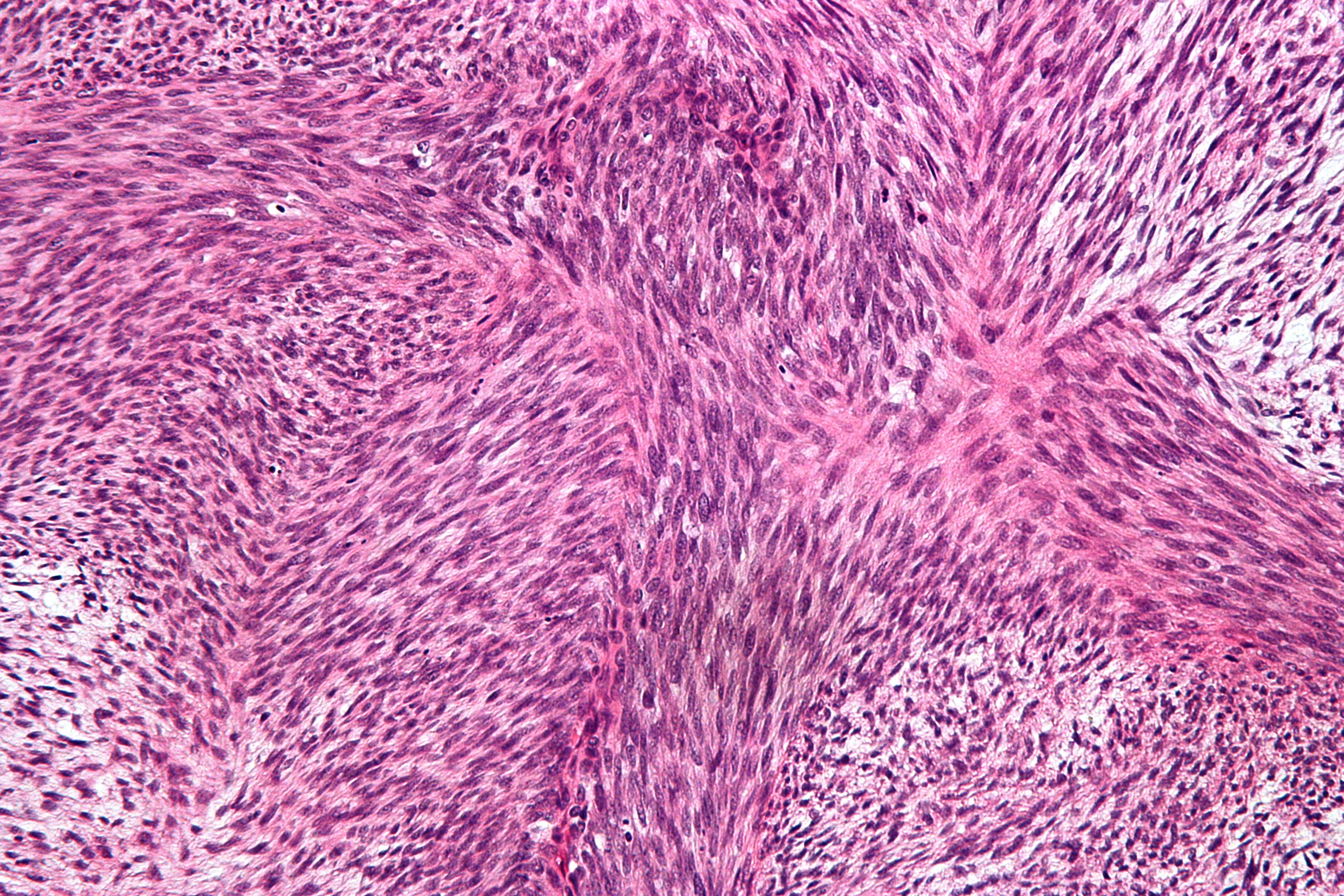 mpnst histology