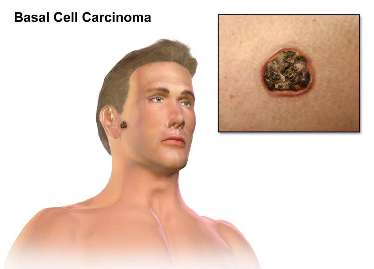 https://upload.wikimedia.org/wikipedia/commons/2/27/Basal_Cell_Carcinoma.png