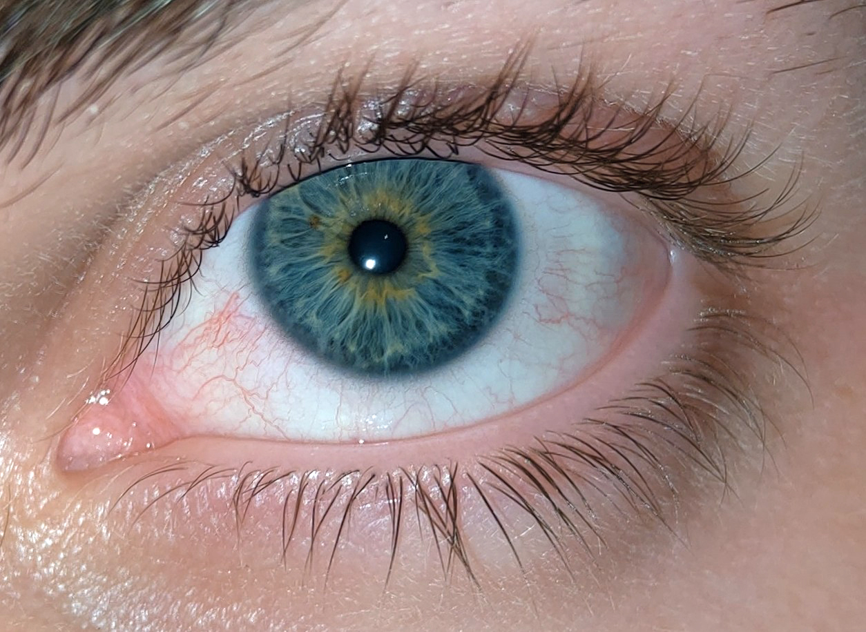Частичная гетерохромия глаз у людей что это такое