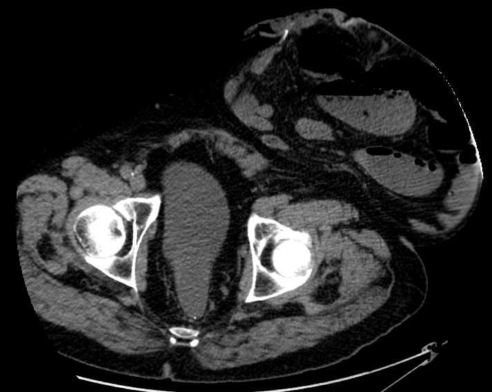 File:Colostomy and parastomal hernia - CT.png