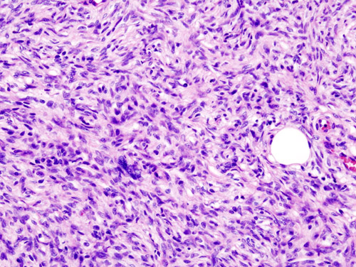 File:Dermatofibrosarcoma protuberans (2) recurrence.JPG