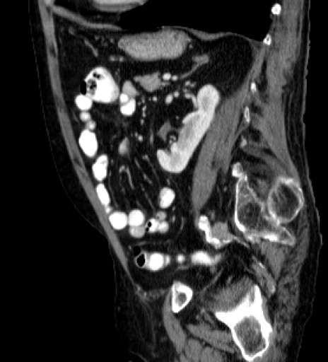 File:Hufeisenniere 07 - CT - sagittal - 031.jpg