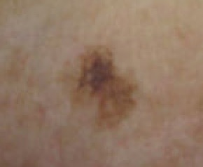 Malignant Melanoma in situ, left upper inner arm (Original Post: Shared in Melanoma)