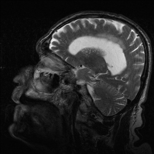 File:NPH MRI 047.png