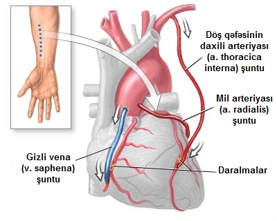 File:Aorta koronar şuntlama.jpg