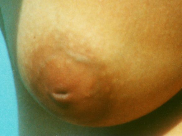 File:Inverted-nipple-04.jpg