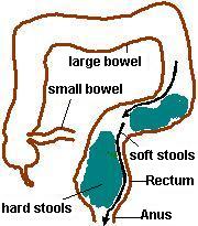 Overflow-Incontinence