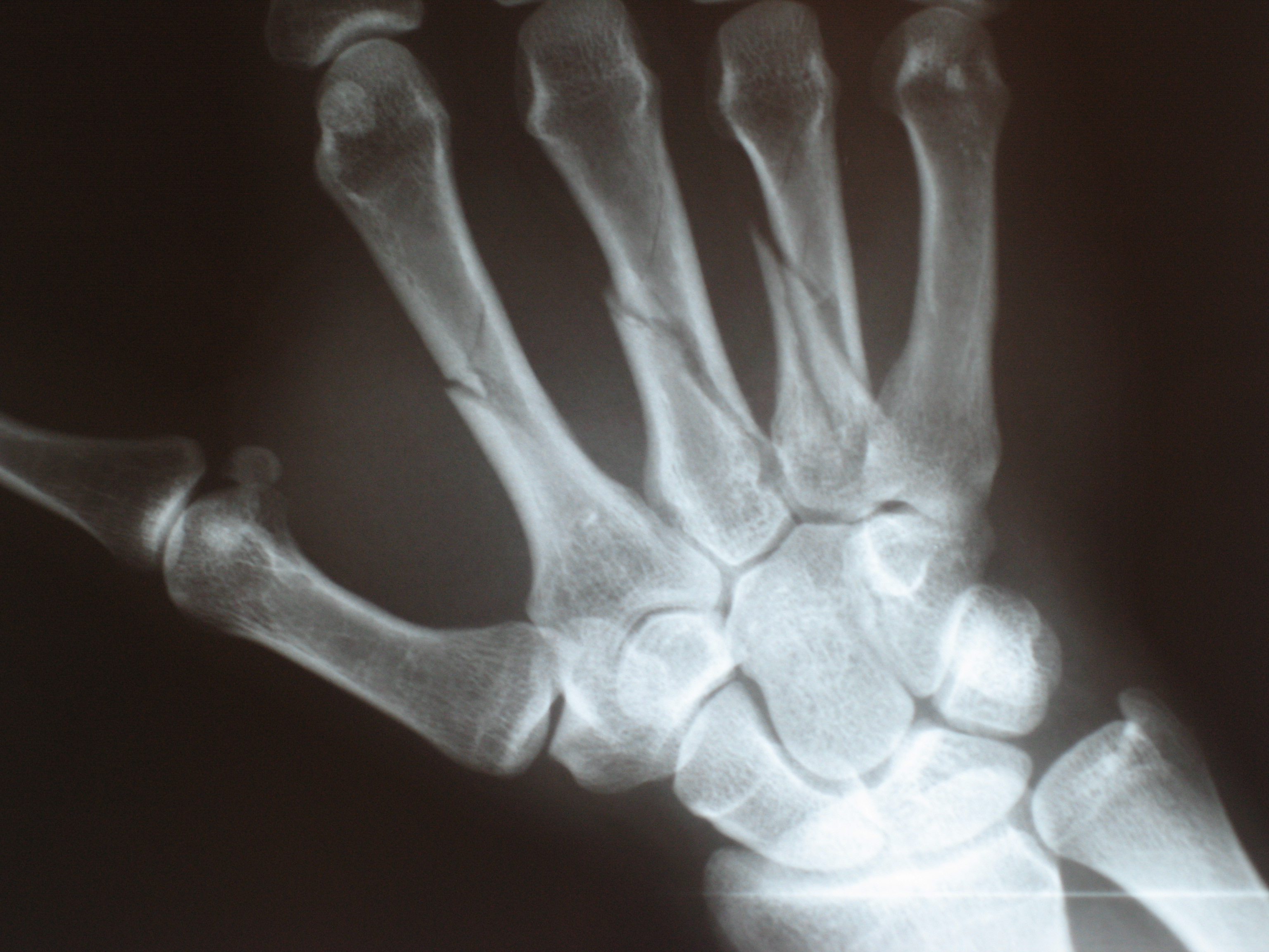 file-metacarpal-fractures-jpg-wikipedia