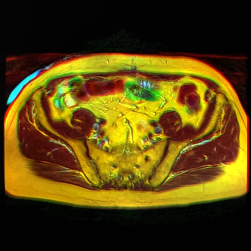 File:Pelvic MRI T1FSE T2Prop T2FSatProp a 16.jpg