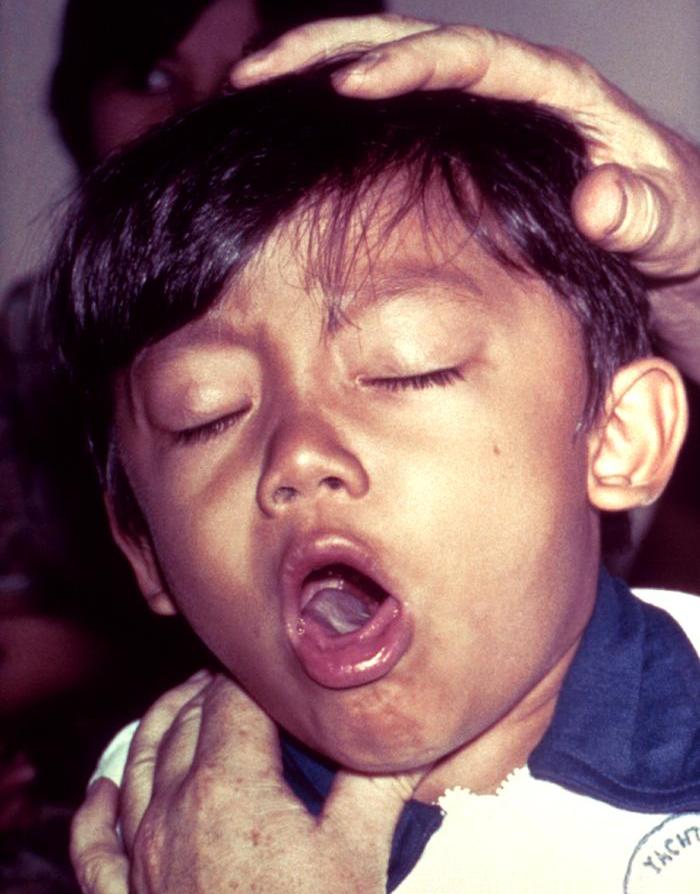 Whooping cough  Wikipedia